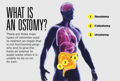 How to Change a Colostomy Bag Step-By-Step – Because Market