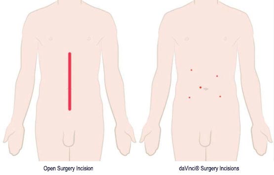 Diagram showing fewer surgical incisions of robotic surgery vs open surgery