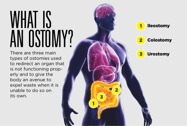 Living With an Ostomy Pouch | MountainView Hospital